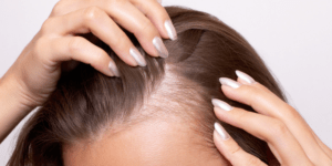 GLP-1 Medication and Hair Loss